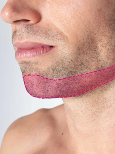 Depilação a laser no queixo homem
