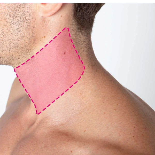 Depilação a laser de díodo em pescoço masculino com remoção progressiva e duradoura do pelo