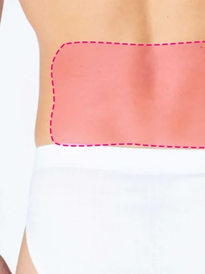Depilação laser de díodo para zona lombar masculina com eliminação do pelo desde a raiz.