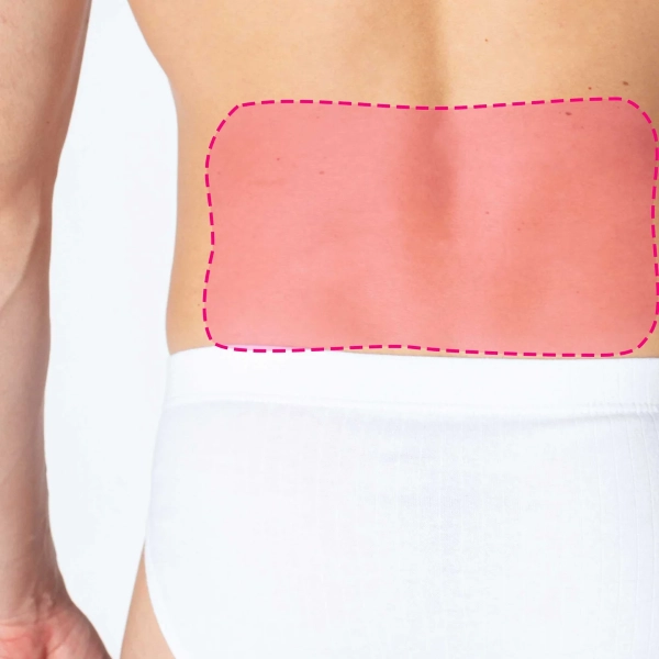 Depilação laser de díodo para zona lombar masculina com eliminação do pelo desde a raiz.