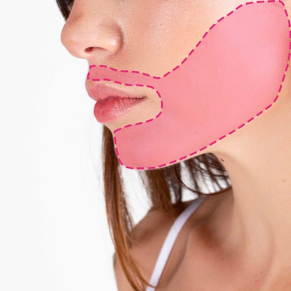 Depilação a laser de diodo na zona da barba feminina