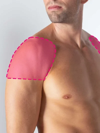 Depilação a laser de díodo em ombros masculinos com remoção progressiva e duradoura do pelo