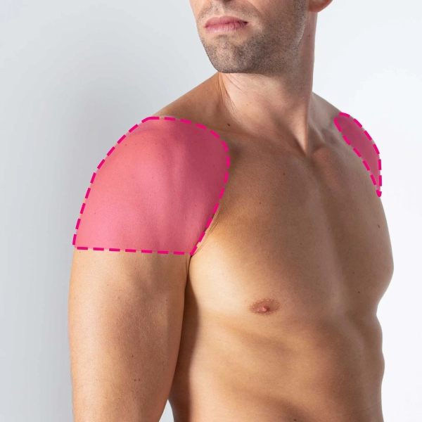 Depilação a laser de díodo em ombros masculinos com remoção progressiva e duradoura do pelo