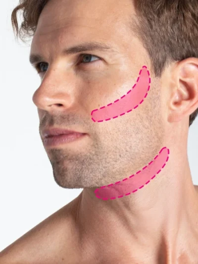 Depilação a laser do contorno da barba masculina com tecnologia de díodo de última geração