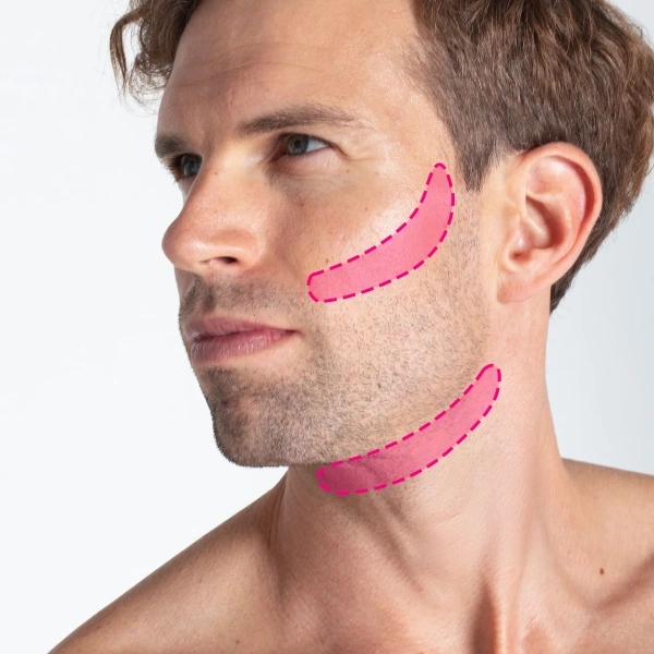 Depilação a laser do contorno da barba masculina com tecnologia de díodo de última geração