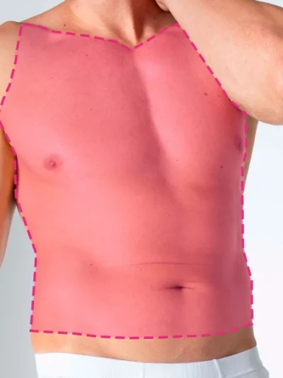 Depilação a laser no tórax completo masculino com tecnología de diodo