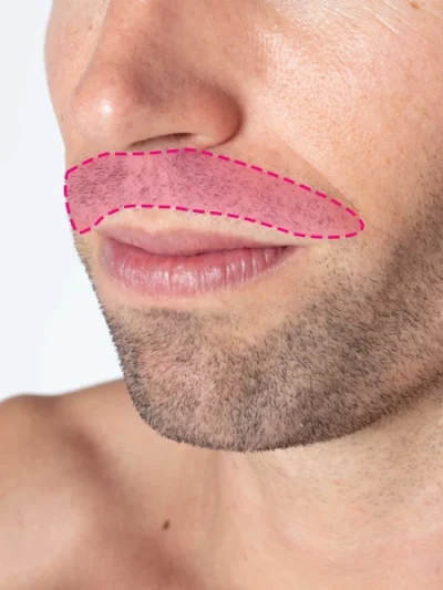 Depilação a laser de díodo na zona do lábio masculino antes e depois do tratamento