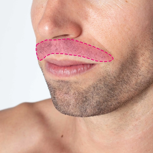 Depilação a laser de díodo na zona do lábio masculino antes e depois do tratamento