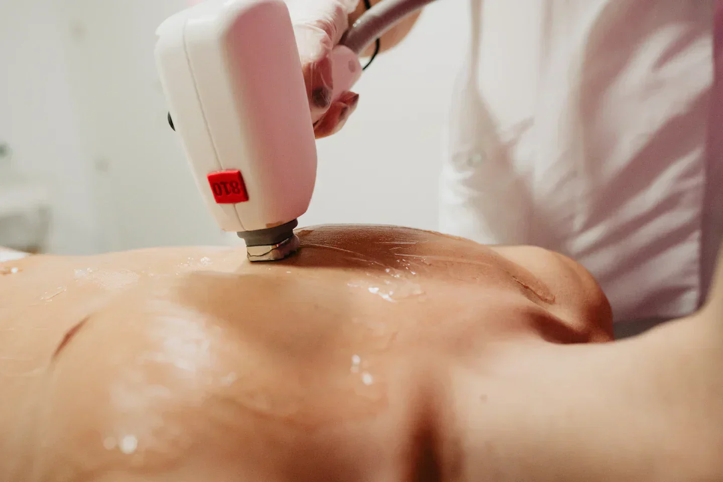 depilação laser zonas guia área corporal
